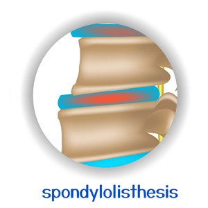 picture of Easley chiropractic spondylolisthesis